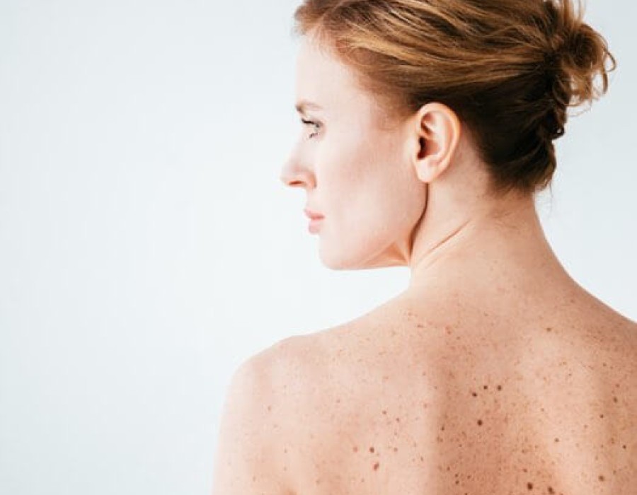 Onze huid - Grootste orgaan van het menselijk lichaam | Flen Health